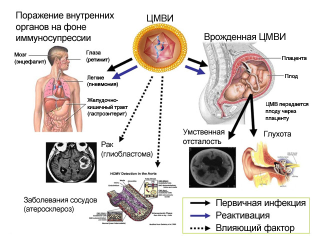 цмв инфекция что это такое